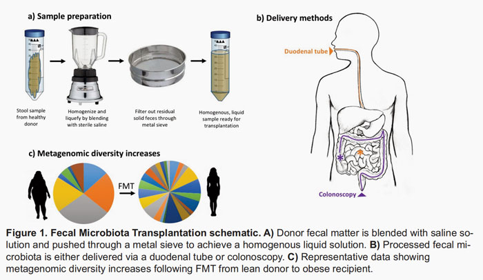 粪菌移植方法 图片来源：《耶鲁生物学和医学杂志》_阅微基因