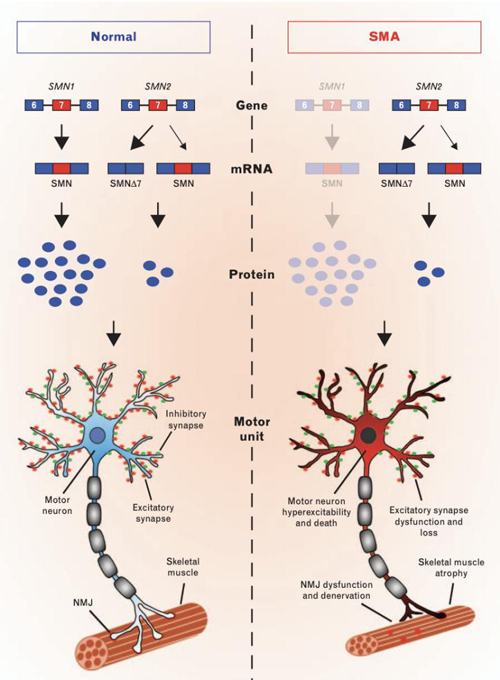 SMA患者的基因缺陷和运动神经元障碍_阅微基因